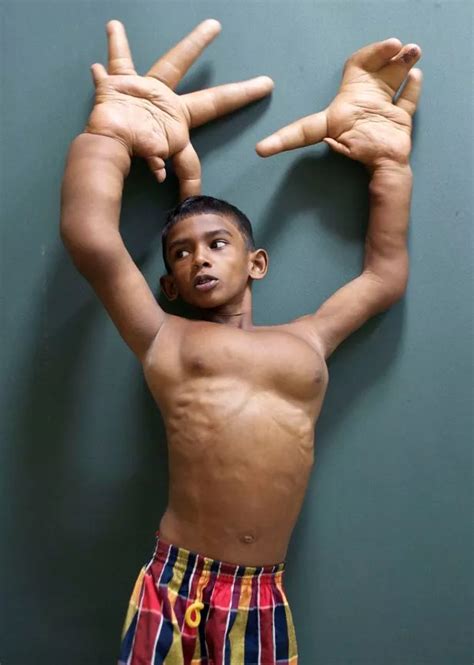 'Boy with the World's Biggest Hands' measuring 33cm has surgery to reduce their size - Mirror Online