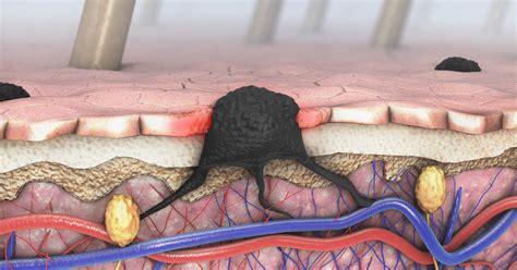 Melanoma—BRAF-Mutated Disease, Checkpoint Inhibitors, Emerging Trends, and Challenging Cases