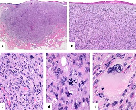 Atypical fibroxanthoma/pleomorphic dermal sarcoma: atypical ...