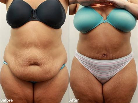 Dr. Darm, Tummy Tuck Before and After Pictures | Tummy tucks, Surgery and Tummy tuck surgery