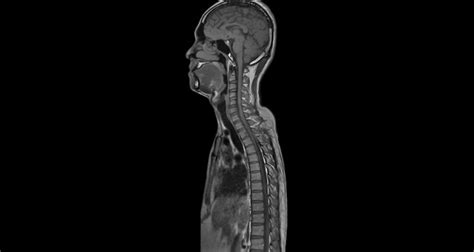 Spinal Cord Lesions & The Risk of Relapse - MStranslate