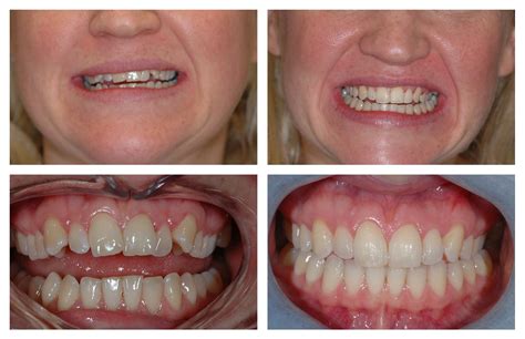 6 Month Smiles, Braces Surrey - Teeth Straightening Treatment