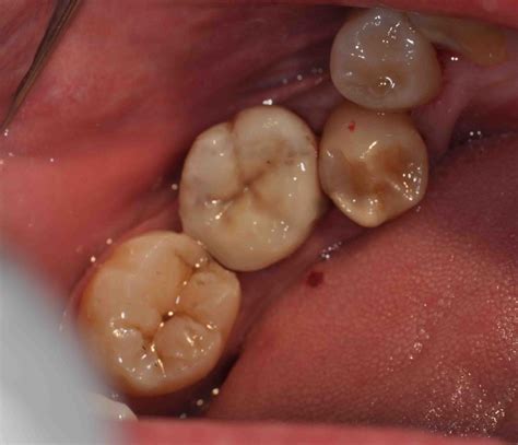 Treatment Options: Dental Aesthetic with White Filling II (On Back Teeth)