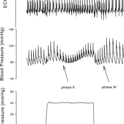 Example of data collection during the Valsalva maneuver showing heart ...