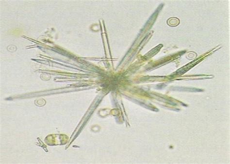 Urine Crystals Test Purpose, Procedure, Results and more - Lab Tests Guide