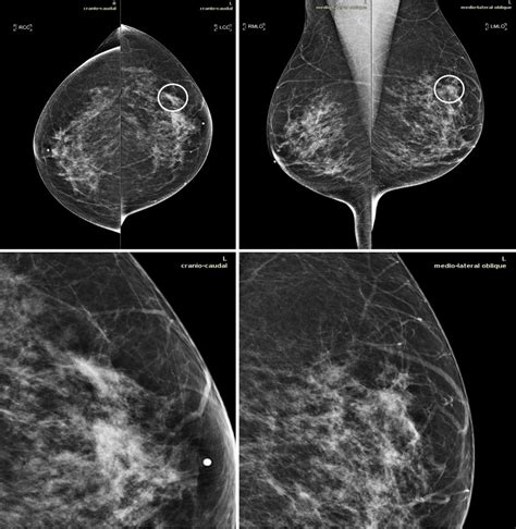 Mammography AI Tool Cleared This Year Improves Breast Cancer Detection | Diagnostic Imaging