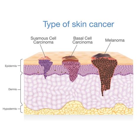 Skin Cancer Treatment