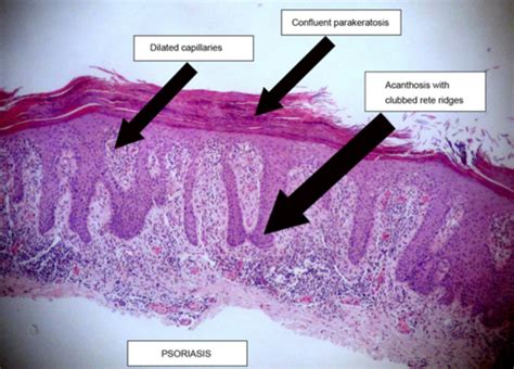 Inflammatory Skin Pathology Flashcards | Quizlet