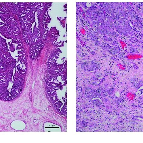 Transitional Cell Carcinoma