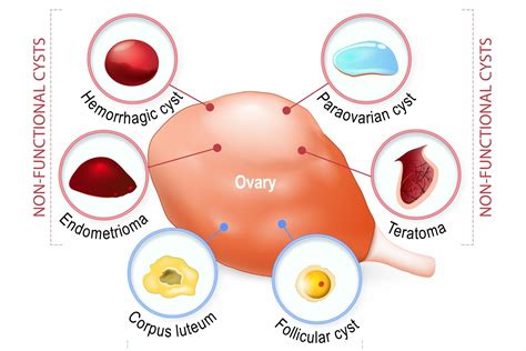 Pcos Cyst – Telegraph