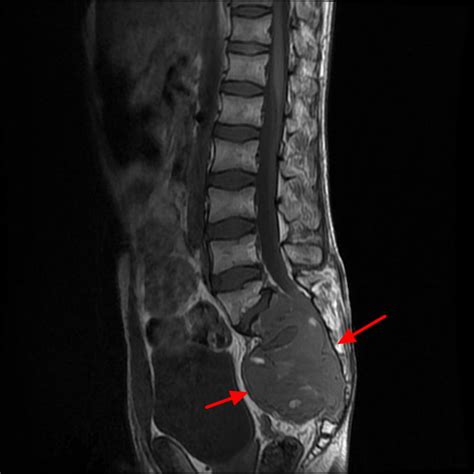 Chordoma Cancer - Causes, Symptoms, Life Expectancy, Treatment