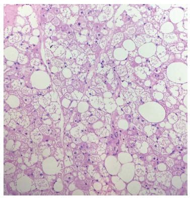 SciELO - Brasil - Mammary Hibernoma: A Case Report of a Rare Disease Mammary Hibernoma: A Case ...