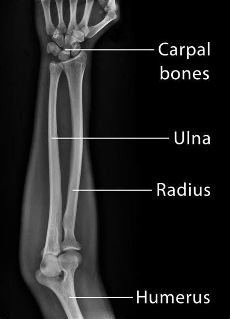 Radius And Ulna X Ray