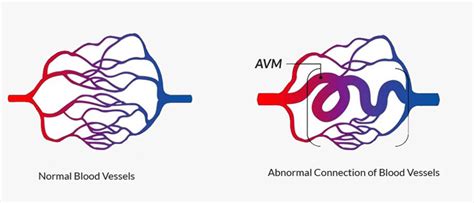 Arteriovenous Malformation Symptoms & Treatment | Stroke & Aneurysm Center