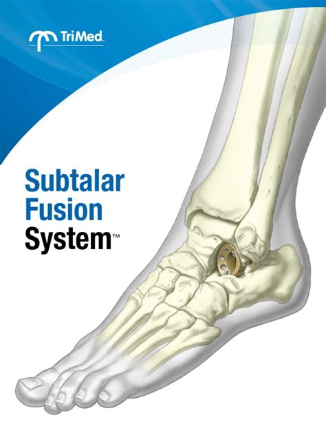 System Brochure - Subtalar Fusion Cup PDF | PDF | Industrial Processes | Surgery