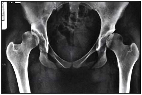 Acetabular Dysplasia | Sydney Orthopaedic Trauma & Reconstructive Surgery