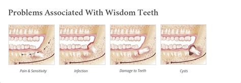 Wisdom Teeth Removal | Oral Surgery Partners