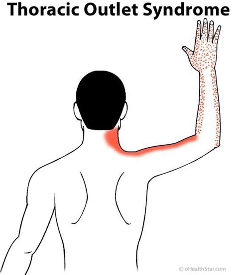 Pin by Chris Eich on PT, MASSAGE, STRETCHING | Shoulder pain, Neck and shoulder pain, Pinched nerve