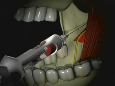 Inferior Alveolar Nerve Block Technique Video