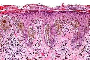 Benign Nevus Histology