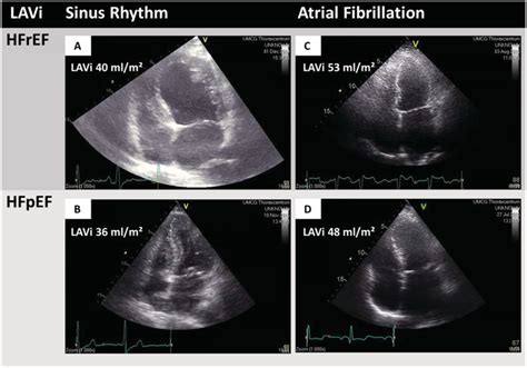 Echocardiography examples of heart failure with reduced ejection ...