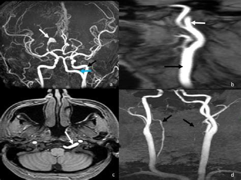 Diagnosis of the dissecting aneurysm of the right posterior cerebral ...