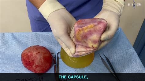 EN BLOC CAPSULECTOMY. April 3rd 2020 / 1 - YouTube