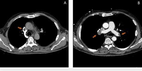 CTA findings. A: Computed tomography angiography (CTA) scan of the ...