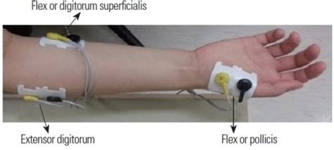 EMG electrode placement. | Open-i