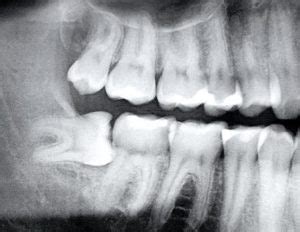 Impacted Wisdom Teeth Panoramic X Ray - TeethWalls