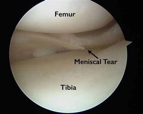 Torn Meniscus – Anatomy and Causes (Video) - Town Center Orthopaedics