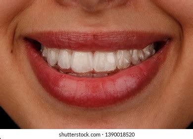 4,882 Invisalign Images, Stock Photos & Vectors | Shutterstock