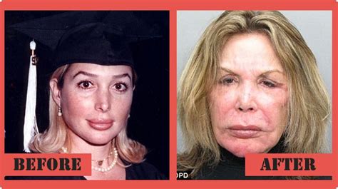 Elsa Patton Plastic Surgery Before and After Facelift Images