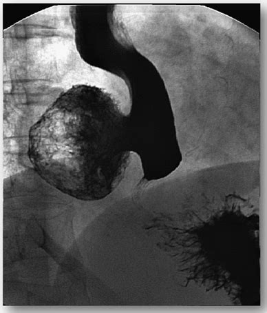 Achalasia and epiphrenic diverticulum. | Download Scientific Diagram