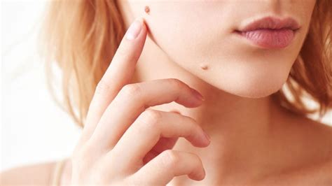 9 Best Mole Removal Clinics in Singapore [2022]