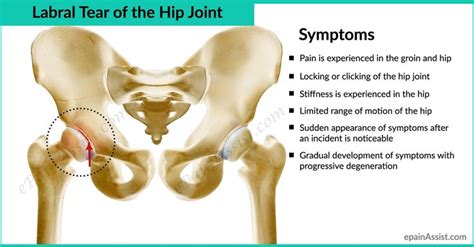 Labral Tear of The Hip Joint-Know Its Causes, Symptoms, and Treatment ...