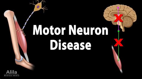 Clinical Manifestation Of Motor Neurone Disease - Infoupdate.org