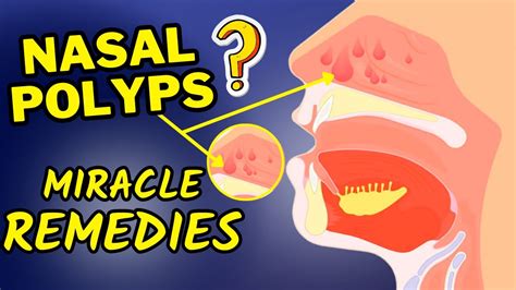 Nasal Polyps Anatomy