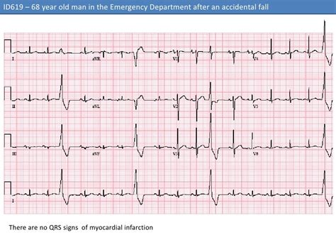 ECG #3 - ID 619 – Premature Ventricular Complexes