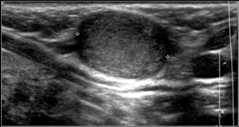 Sebaceous Cyst Vs Lipoma Ultrasound | Sitelip.org