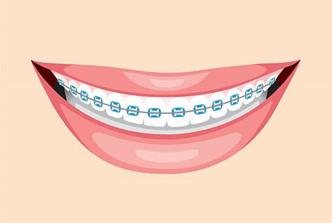 Royalty Free Braces Clip Art, Vector Images & Illustrations - iStock