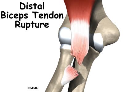 Distal Biceps Tendon Rupture: Biceps Tear | Houston Methodist