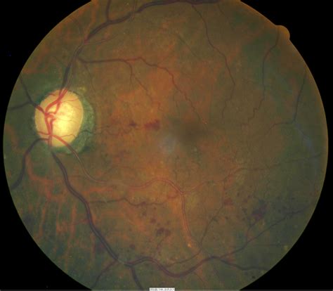 Hypertensive Retinopathy Stages