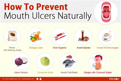 How To Prevent Mouth Ulcers Naturally - By Dr. Dinesh Rawal | Lybrate