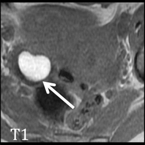 Complex Gartner’s duct cyst (solid arrow) with moderate T2 intensity,... | Download Scientific ...