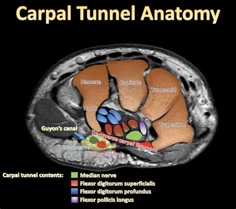 Carpal Tunnel Syndrome - WikiSM (Sports Medicine Wiki)