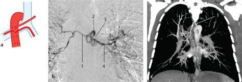 Bronchial Arteries (Rami Bronchiales) | Radiology Key