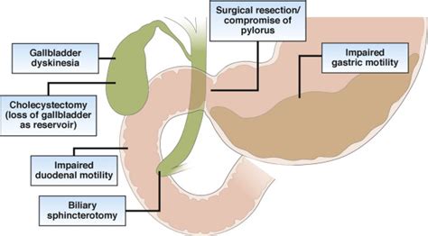 New Causes for the Old Problem of Bile Reflux Gastritis - Clinical ...