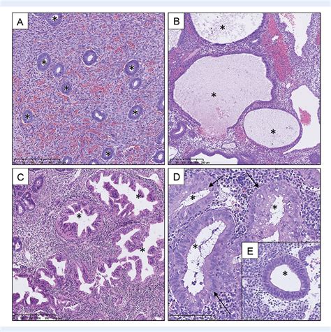 [PDF] New concepts for an old problem: the diagnosis of endometrial hyperplasia | Semantic Scholar