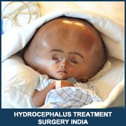 Hydrocephalus Treatment Surgery India - Home